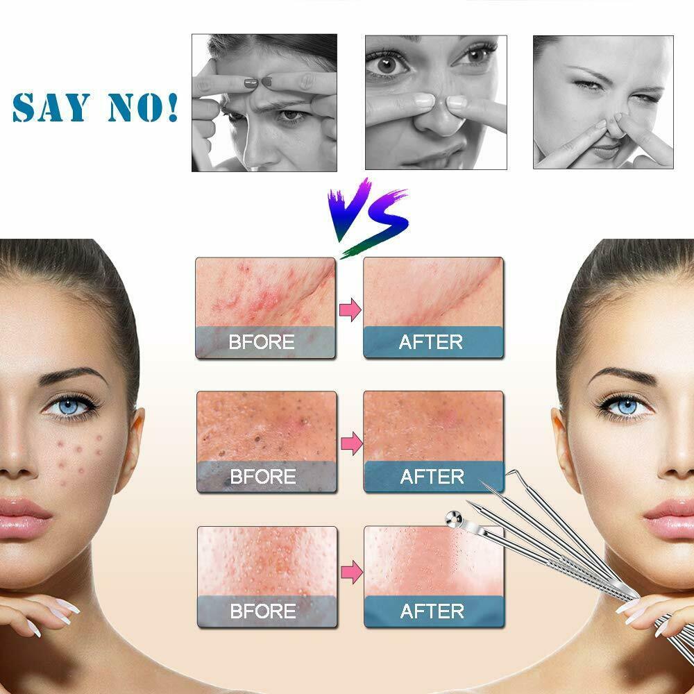 Blackhead & Ear Wax Remover Set